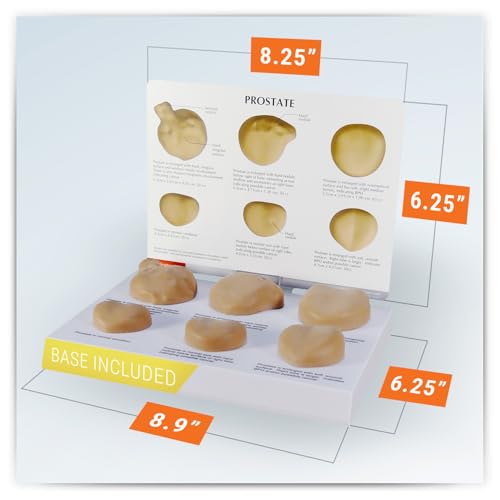GPI Anatomicals Prostate Model Set, Replica with Pathologies - style: Prostate Model