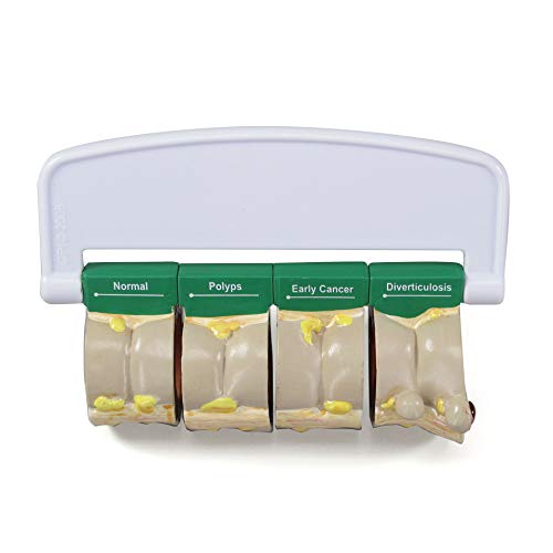 GPI Anatomicals 4-Piece Colon Model, Replica with Pathologies - style: Colon Model