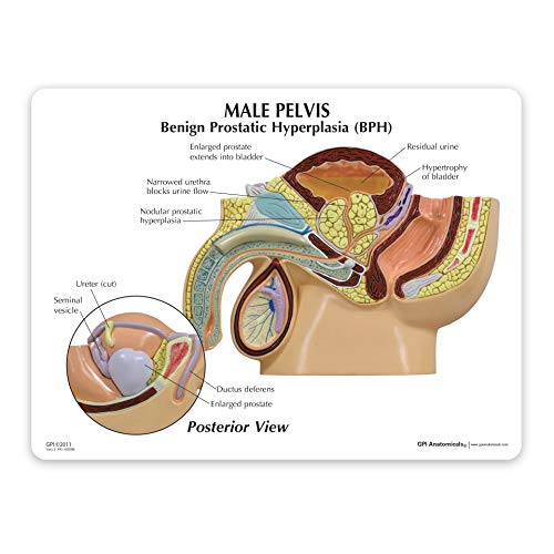 GPI Anatomicals Male Pelvis Model with Benign Prostatic Hyperplasia (BPH) - style: Male Pelvis with Benign Prostatic Hyperplasia