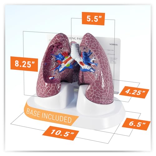 GPI Anatomicals Lung Model Set with Pathologies - style: Lung Model with Pathologies