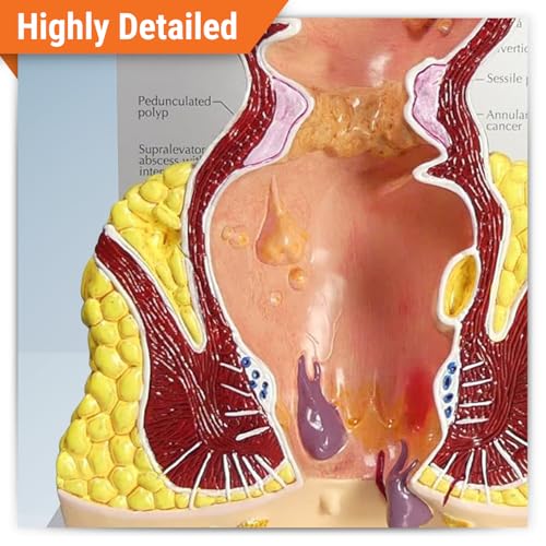 GPI Anatomicals Human Rectum Model with Common Pathologies
