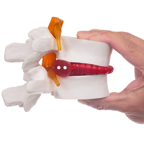 Human Anatomical Lumbar Disc Herniation Model, 1.5 Times Life Size Lumbar Vertebrae Disc Herniation Model, Portable Lumbar Spine Model for Medical, Teaching and Demonstrating - style: Anatomical Lumbar Disc Herniation Model