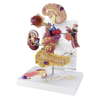GPI Anatomicals Type II Diabetes Model Set - style: Type II Diabetes Model