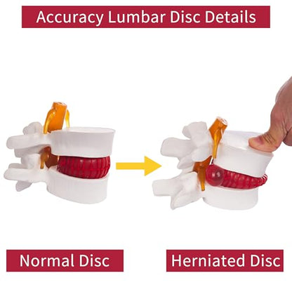 Human Anatomical Lumbar Disc Herniation Model, 1.5 Times Life Size Lumbar Vertebrae Disc Herniation Model, Portable Lumbar Spine Model for Medical, Teaching and Demonstrating - style: Anatomical Lumbar Disc Herniation Model