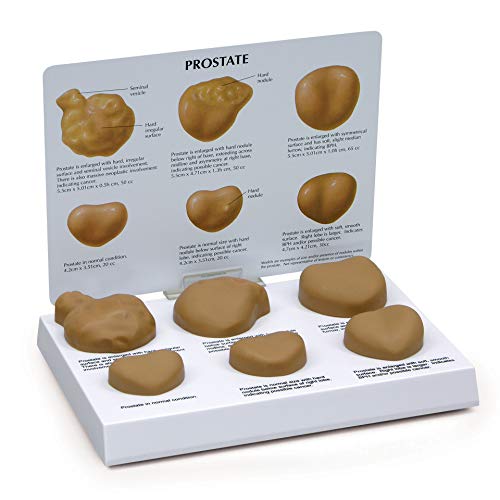 GPI Anatomicals Prostate Model Set, Replica with Pathologies - style: Prostate Model