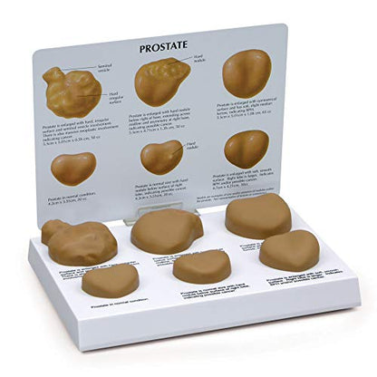 GPI Anatomicals Prostate Model Set, Replica with Pathologies - style: Prostate Model