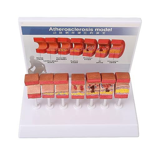 Anatomy Replica Model, Atherosclerosis Human Body Artery Model Bright Colors Simulation Ecofriendly PVC for Educational Tool