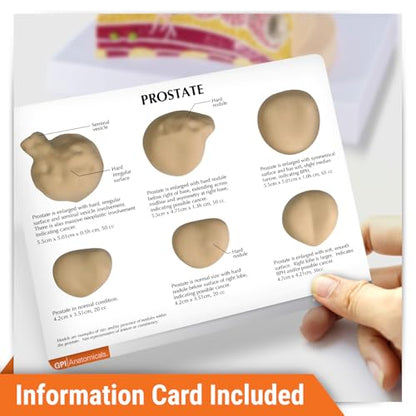 GPI Anatomicals Prostate Model Set, Replica with Pathologies - style: Prostate Model