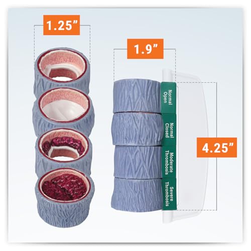 GPI Anatomicals 4-Piece Vein Model, Replica of a Vein with Blood Clot - style: Vein with Blood Clot Model