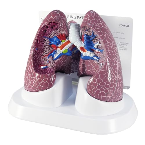 GPI Anatomicals Lung Model Set with Pathologies - style: Lung Model with Pathologies