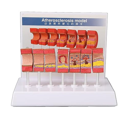 Anatomy Replica Model, Atherosclerosis Human Body Artery Model Bright Colors Simulation Ecofriendly PVC for Educational Tool