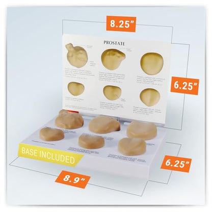 GPI Anatomicals Prostate Model Set, Replica with Pathologies - style: Prostate Model
