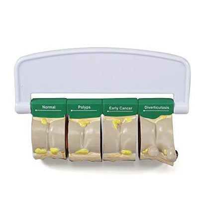 GPI Anatomicals 4-Piece Colon Model, Replica with Pathologies - style: Colon Model