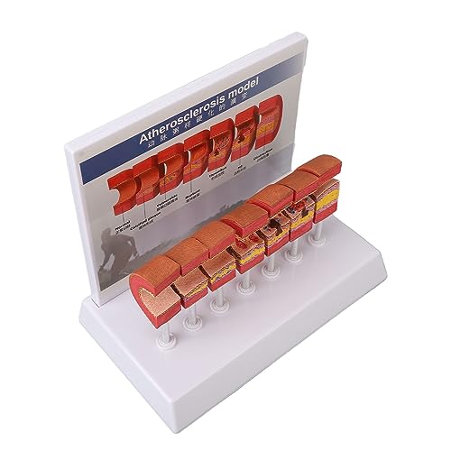 Anatomy Replica Model, Atherosclerosis Human Body Artery Model Bright Colors Simulation Ecofriendly PVC for Educational Tool
