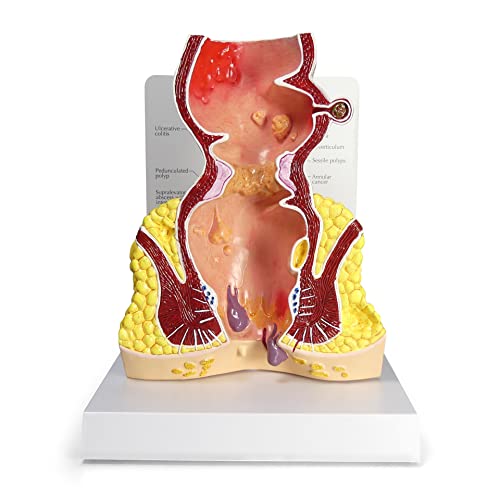 GPI Anatomicals Human Rectum Model with Common Pathologies