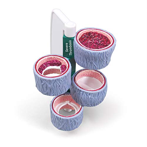 GPI Anatomicals 4-Piece Vein Model, Replica of a Vein with Blood Clot - style: Vein with Blood Clot Model