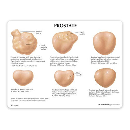 GPI Anatomicals Prostate Model Set, Replica with Pathologies - style: Prostate Model