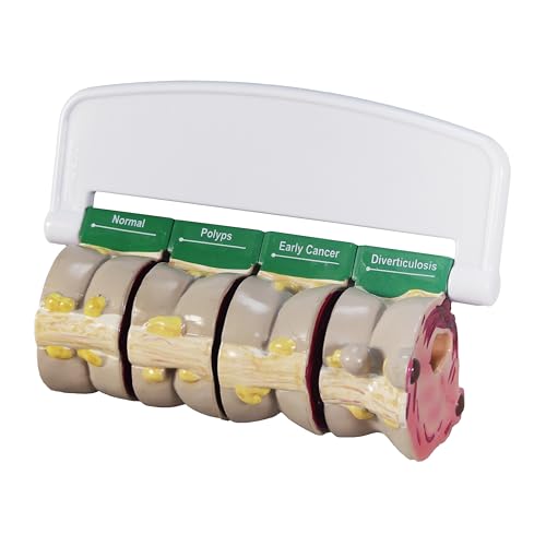 GPI Anatomicals 4-Piece Colon Model, Replica with Pathologies - style: Colon Model