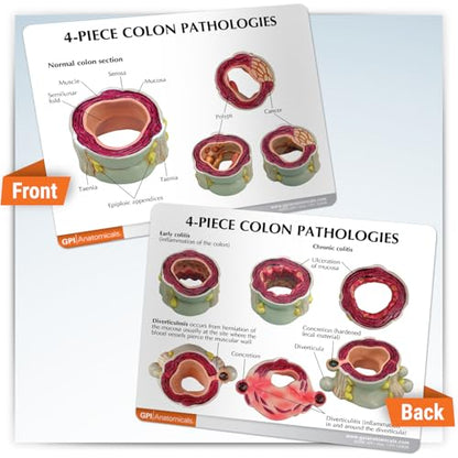 GPI Anatomicals 4-Piece Colon Model, Replica with Pathologies - style: Colon Model