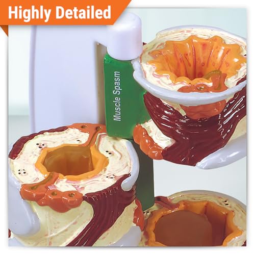 GPI Anatomicals 4-Piece Bronchus Model, Replica with Pathologies - style: Bronchus Model