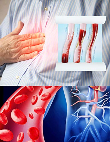 Atherosclerosis Artery Model, LDL Plaque Cardiovascular Teaching Aid