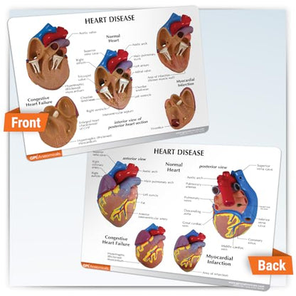 GPI Anatomicals 3-Piece Mini Heart Model Set, Normal and Diseased - style: Mini-Heart Model