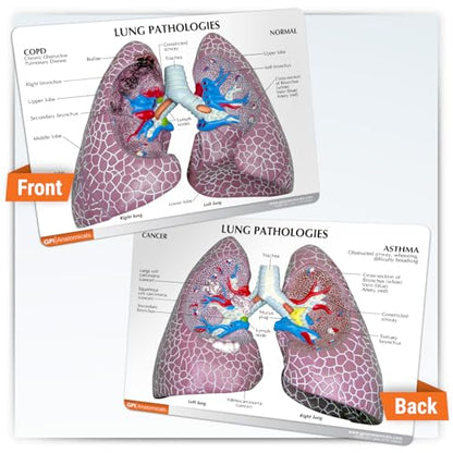 GPI Anatomicals Lung Model Set with Pathologies - style: Lung Model with Pathologies