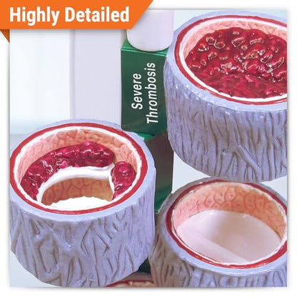 GPI Anatomicals 4-Piece Vein Model, Replica of a Vein with Blood Clot - style: Vein with Blood Clot Model