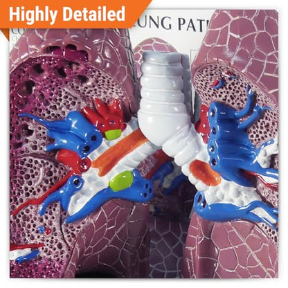 GPI Anatomicals Lung Model Set with Pathologies - style: Lung Model with Pathologies